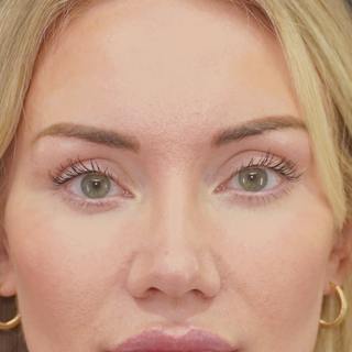 Upper Blepharoplasty Before & After Gallery - Patient 253391 - Image 2
