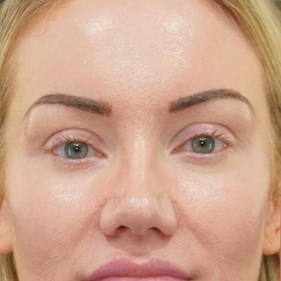 Upper Blepharoplasty Before & After Gallery - Patient 253391 - Image 1