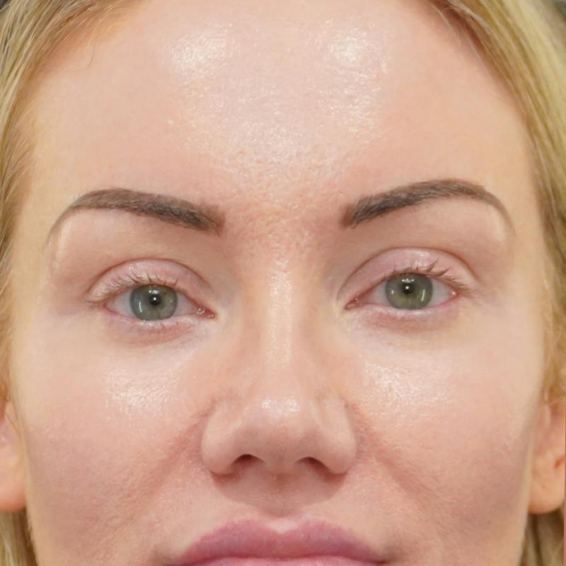 Upper Blepharoplasty Before & After Gallery - Patient 253391 - Image 1