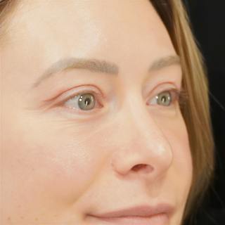 Upper Blepharoplasty Before & After Gallery - Patient 279432 - Image 4