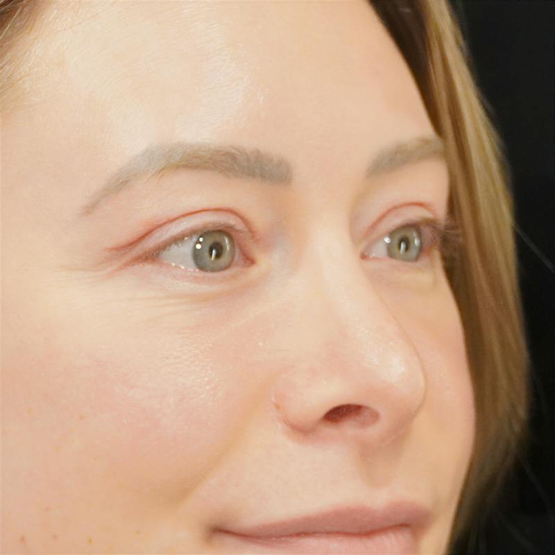 Upper Blepharoplasty Before & After Gallery - Patient 279432 - Image 4