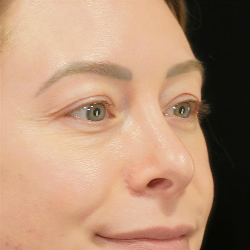Upper Blepharoplasty Before & After Gallery - Patient 279432 - Image 3