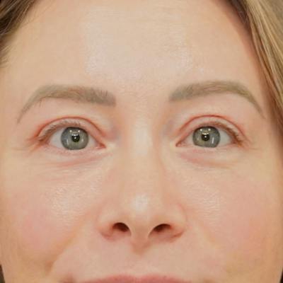 Upper Blepharoplasty Before & After Gallery - Patient 279432 - Image 2