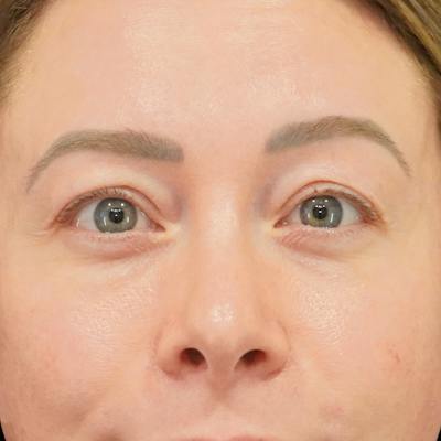 Upper Blepharoplasty Before & After Gallery - Patient 279432 - Image 1