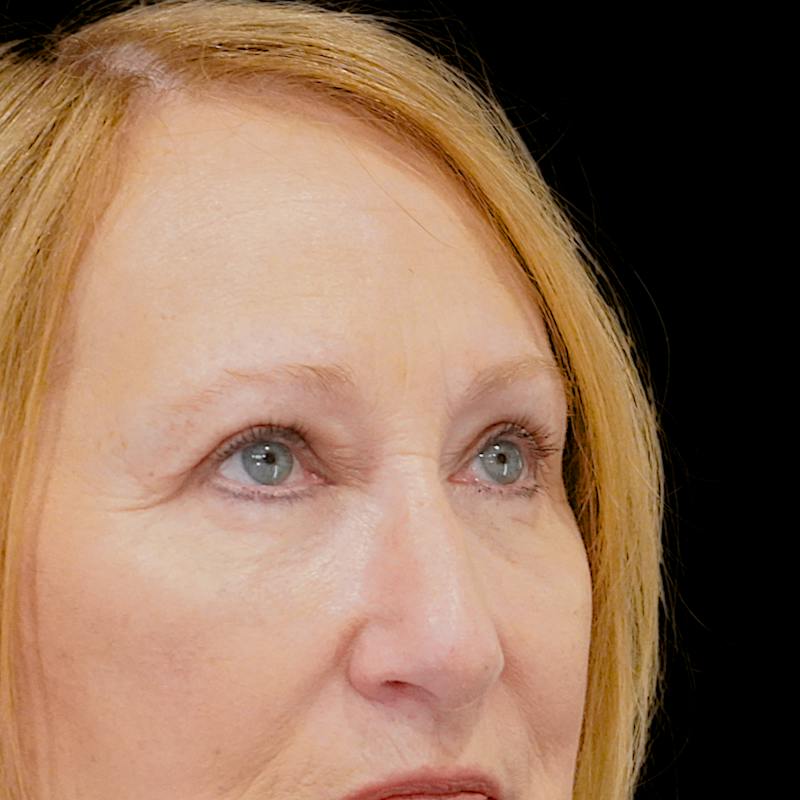 Quad Blepharoplasty Before & After Gallery - Patient 136875 - Image 3