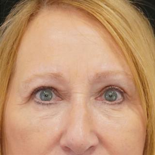 Quad Blepharoplasty Before & After Gallery - Patient 136875 - Image 2