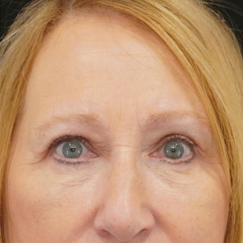 Quad Blepharoplasty Before & After Gallery - Patient 136875 - Image 2