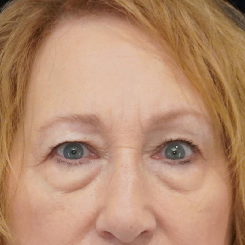 Quad Blepharoplasty Before & After Gallery - Patient 136875 - Image 1