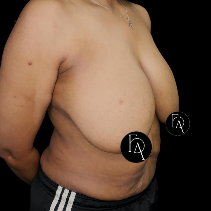 Mommy Makeover Before & After Gallery - Patient 334246 - Image 3