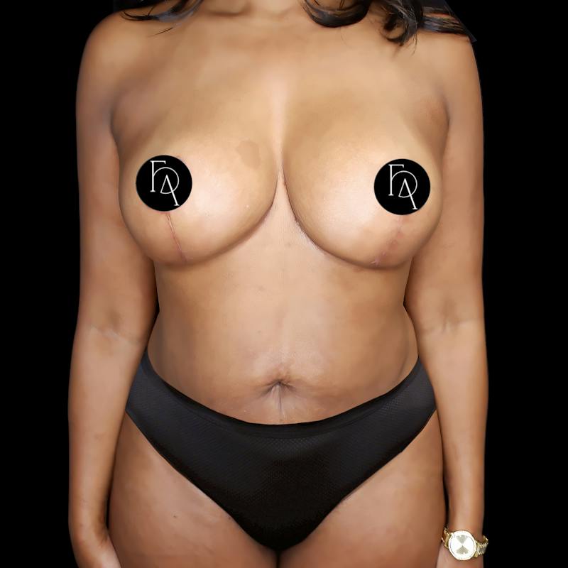 Mommy Makeover Before & After Gallery - Patient 334246 - Image 2