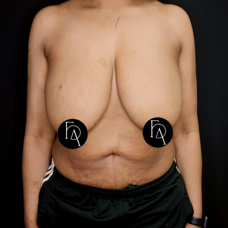 Mommy Makeover Before & After Gallery - Patient 334246 - Image 1