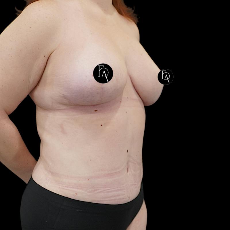 Mommy Makeover Before & After Gallery - Patient 183243 - Image 4