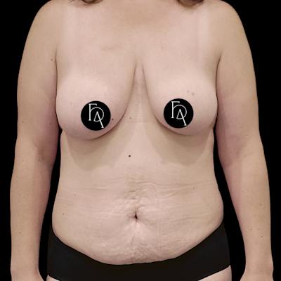 Mommy Makeover Before & After Gallery - Patient 183243 - Image 1