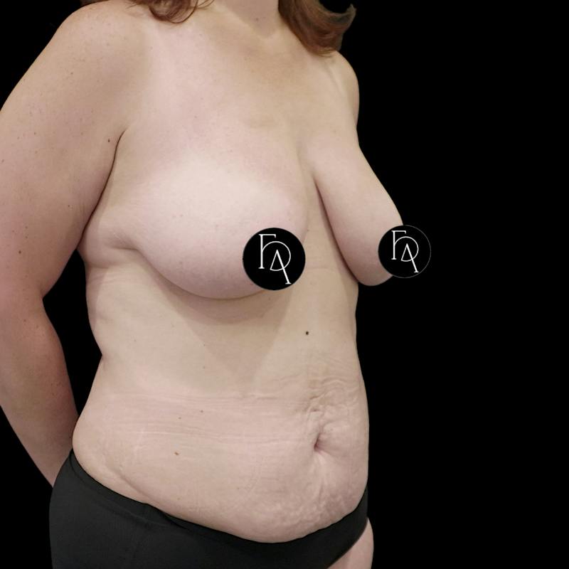 Mommy Makeover Before & After Gallery - Patient 183243 - Image 3