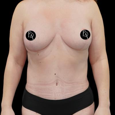 Mommy Makeover Before & After Gallery - Patient 183243 - Image 2