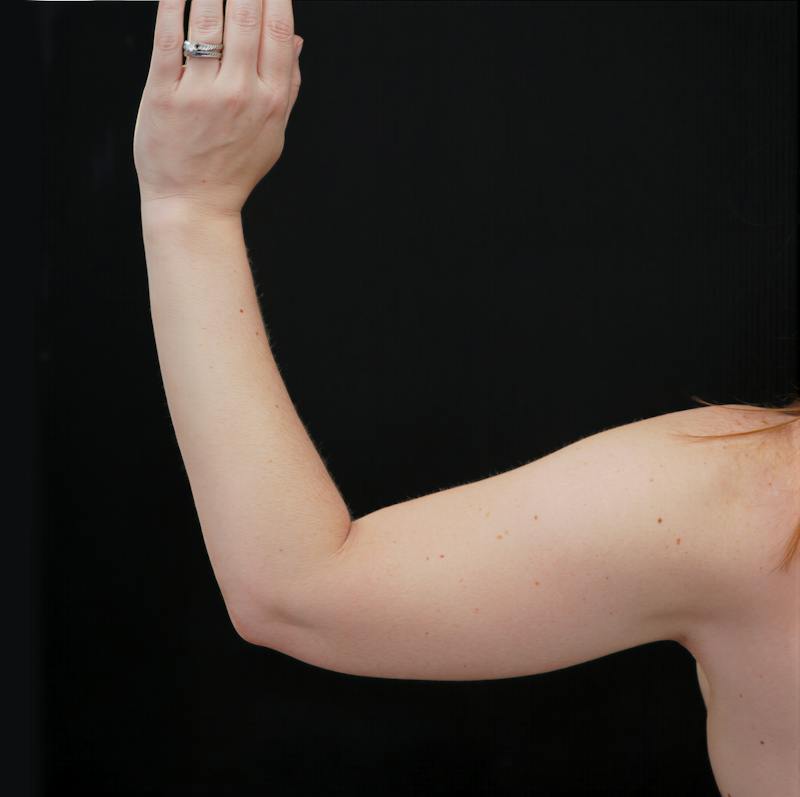 Short Scar Arm Lift Before & After Gallery - Patient 231186 - Image 2