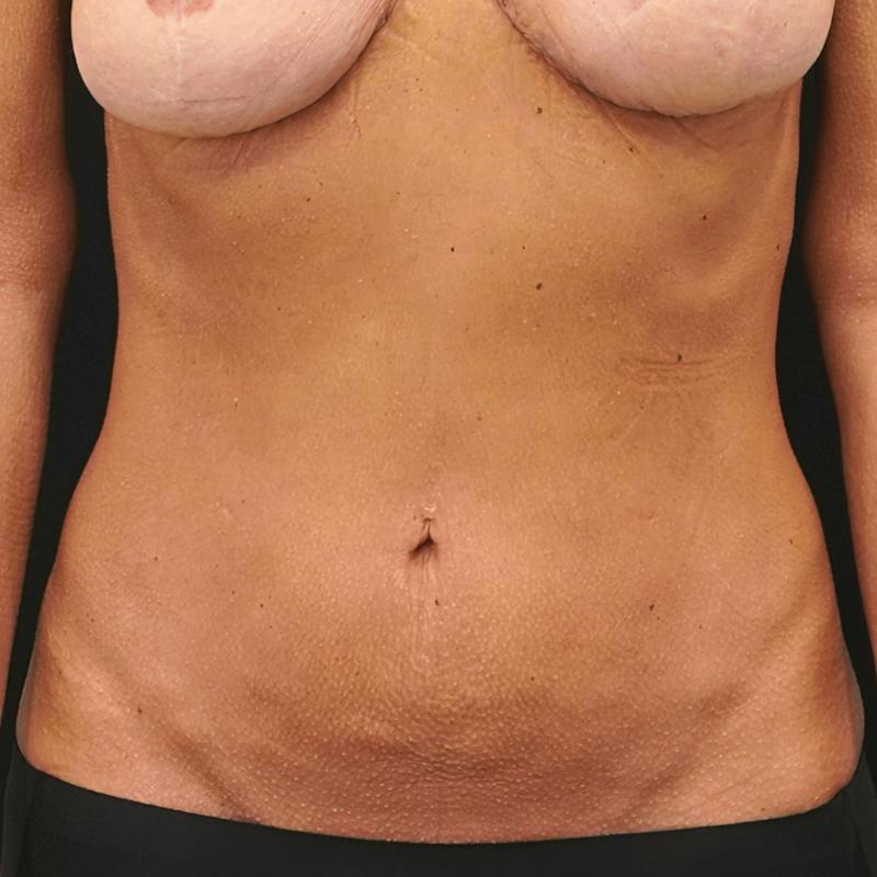 Reverse Tummy Tuck Before & After Gallery - Patient 225881 - Image 2