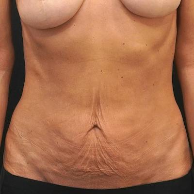 Reverse Tummy Tuck Before & After Gallery - Patient 225881 - Image 1