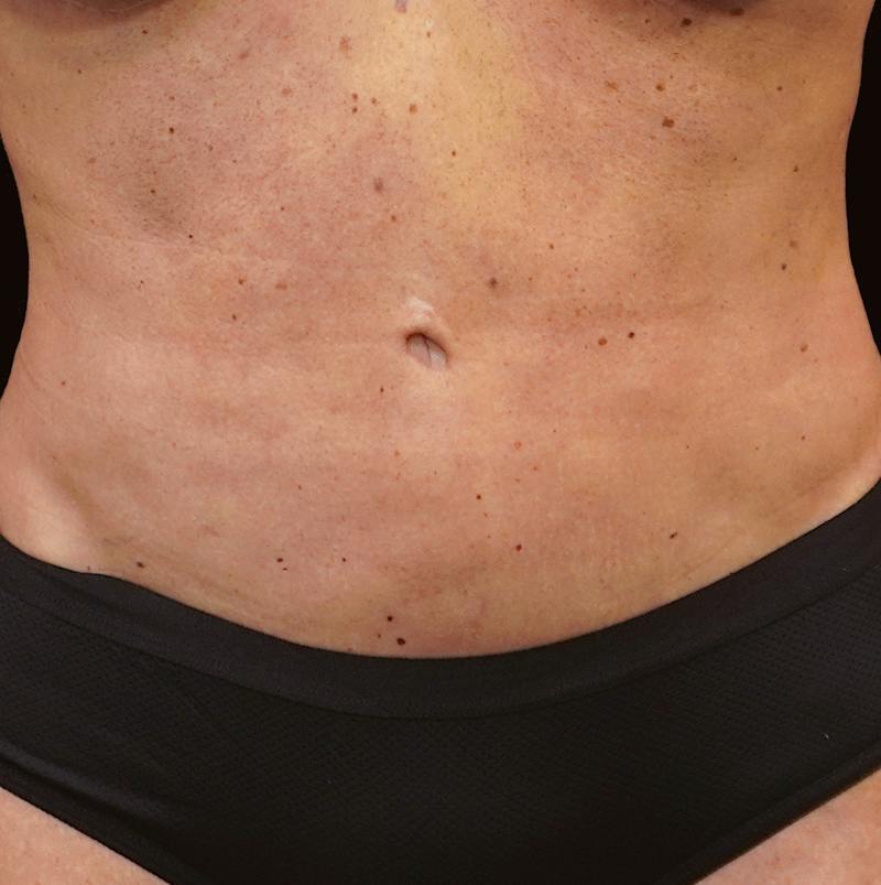 Reverse Tummy Tuck Before & After Gallery - Patient 180953 - Image 2