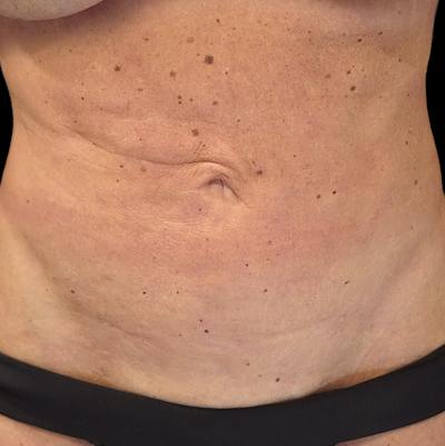 Reverse Tummy Tuck Before & After Gallery - Patient 180953 - Image 1
