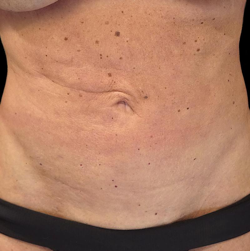 Reverse Tummy Tuck Before & After Gallery - Patient 180953 - Image 1