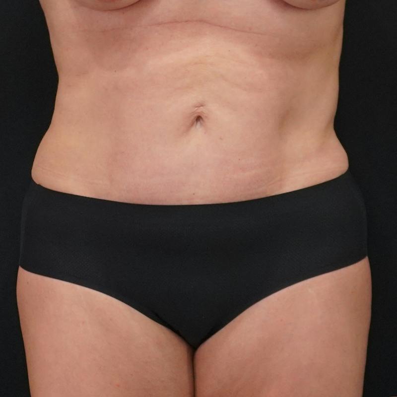 Reverse Tummy Tuck Before & After Gallery - Patient 307567 - Image 2