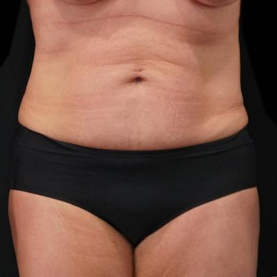 Reverse Tummy Tuck Before & After Gallery - Patient 307567 - Image 1