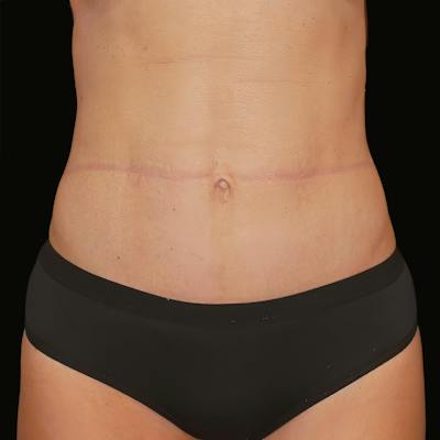 Reverse Tummy Tuck Before & After Gallery - Patient 531971 - Image 2