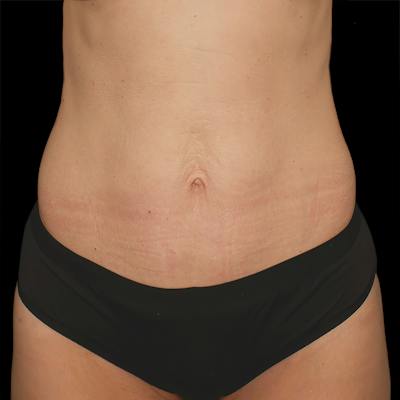Reverse Tummy Tuck Before & After Gallery - Patient 531971 - Image 1