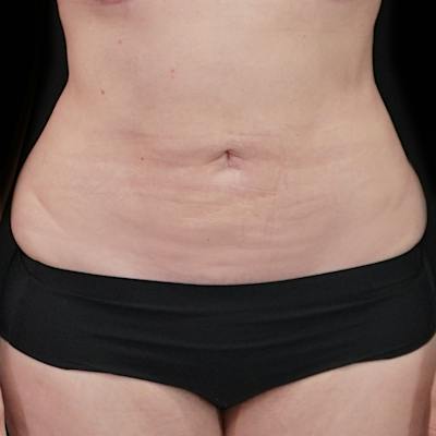 Reverse Tummy Tuck Before & After Gallery - Patient 353460 - Image 2