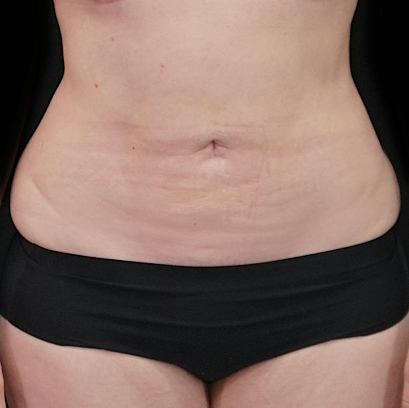 Reverse Tummy Tuck Before & After Gallery - Patient 353460 - Image 2