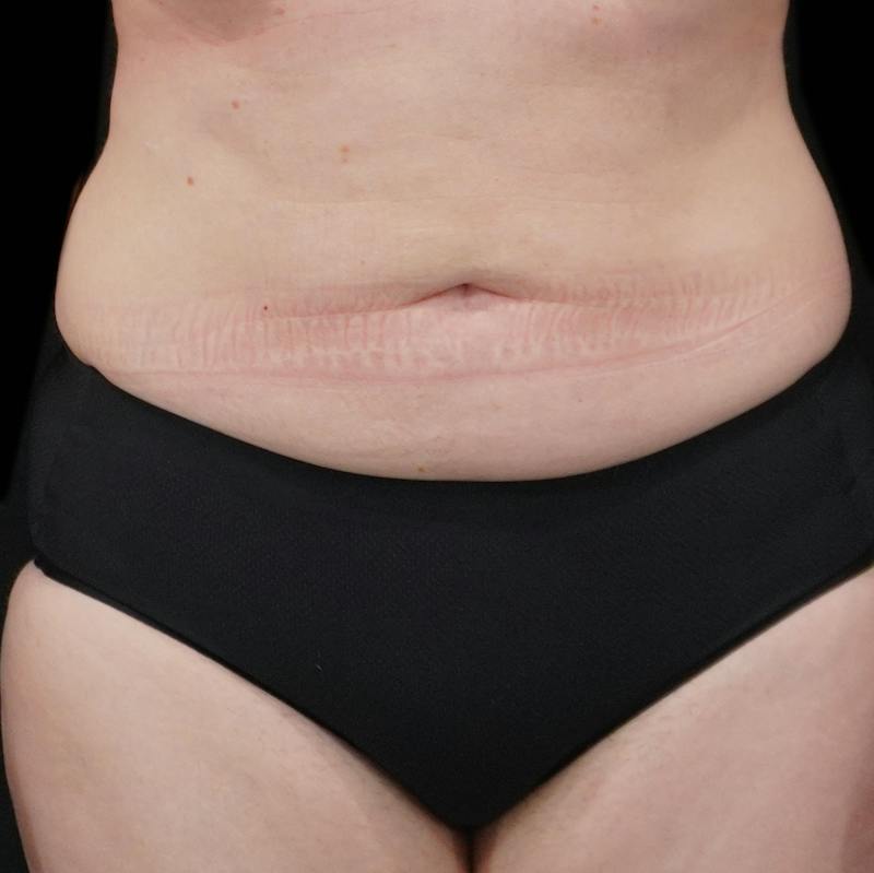 Reverse Tummy Tuck Before & After Gallery - Patient 353460 - Image 1