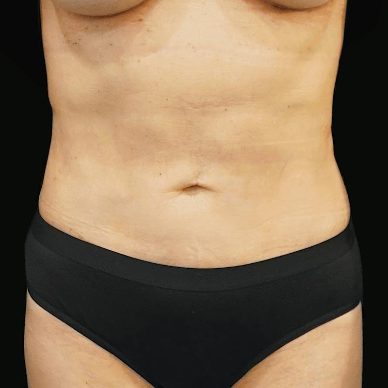 Reverse Tummy Tuck Before & After Gallery - Patient 252626 - Image 2