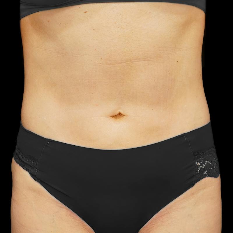 Reverse Tummy Tuck Before & After Gallery - Patient 252626 - Image 1
