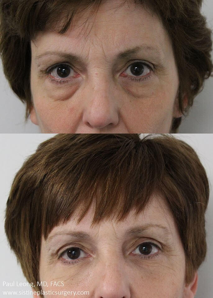 Leong Aesthetics Blog | What You Can Do To Minimize Bruising Before Your Tear Trough Correction Appointment