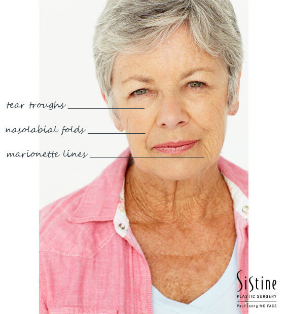 Leong Aesthetics Blog | Dermal Fillers For Marionette Lines (AKA “Puppet Lines”)