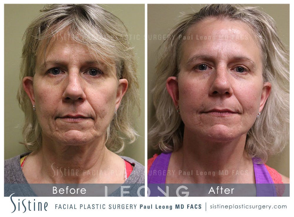 Facelift Before & After Gallery - Patient 4883637 - Image 1