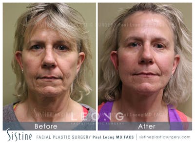 Facelift Before & After Gallery - Patient 4883637 - Image 1