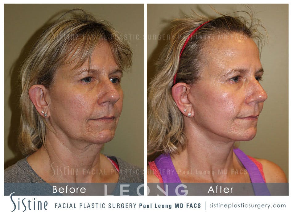 Facelift Before & After Gallery - Patient 4883637 - Image 2