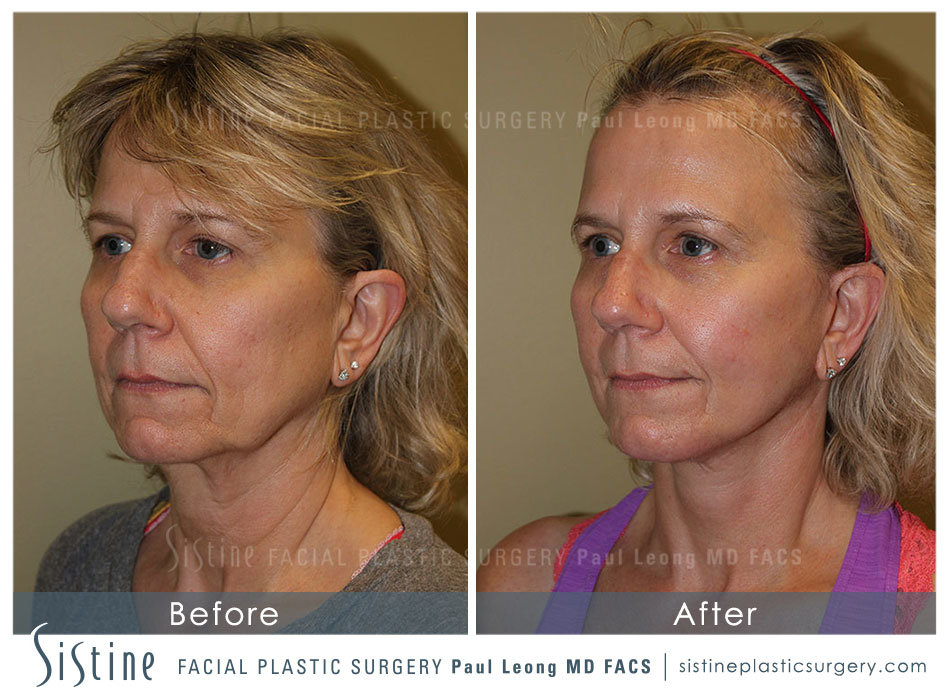 Facelift Before & After Gallery - Patient 4883637 - Image 3