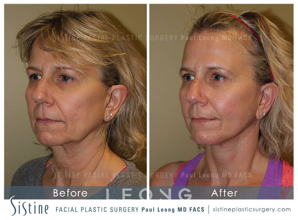 Facelift Before & After Gallery - Patient 4883637 - Image 3