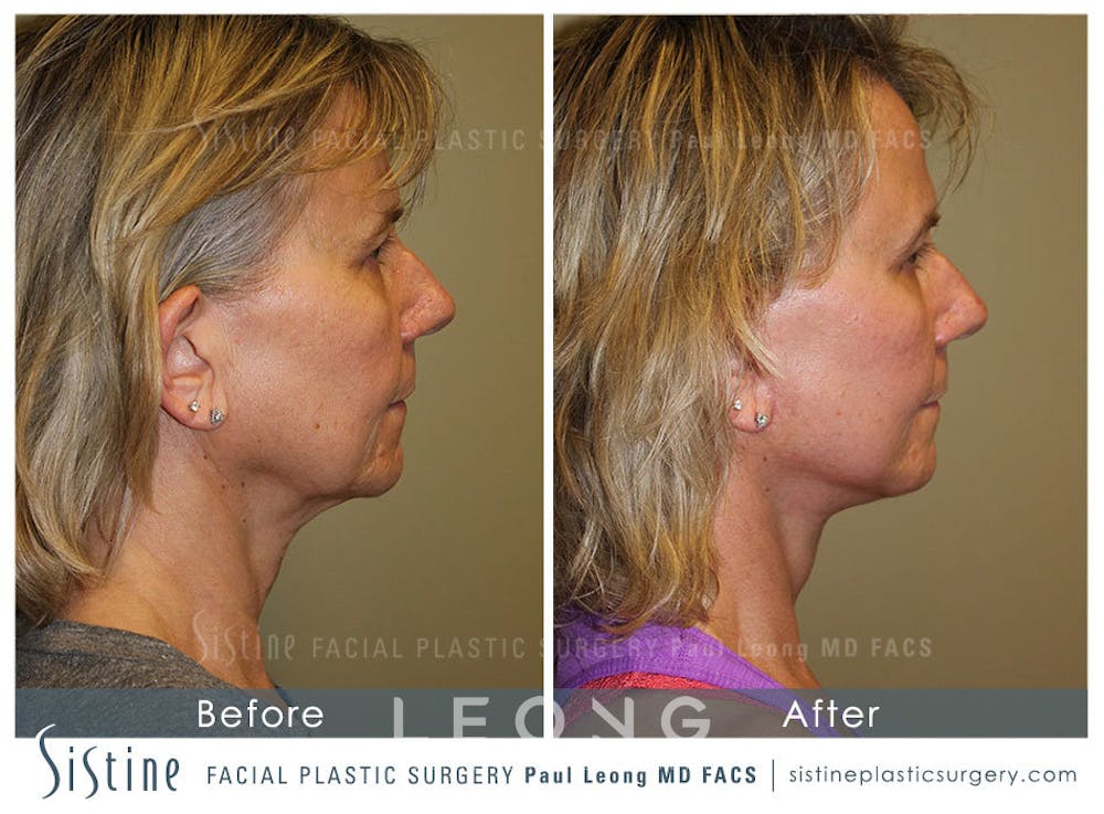 Facelift Before & After Gallery - Patient 4883637 - Image 4