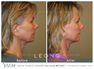 Facelift Before & After Gallery - Patient 4883637 - Image 4