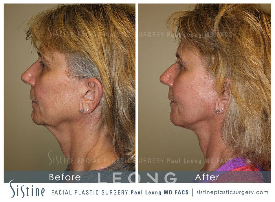 Facelift Before & After Gallery - Patient 4883637 - Image 5