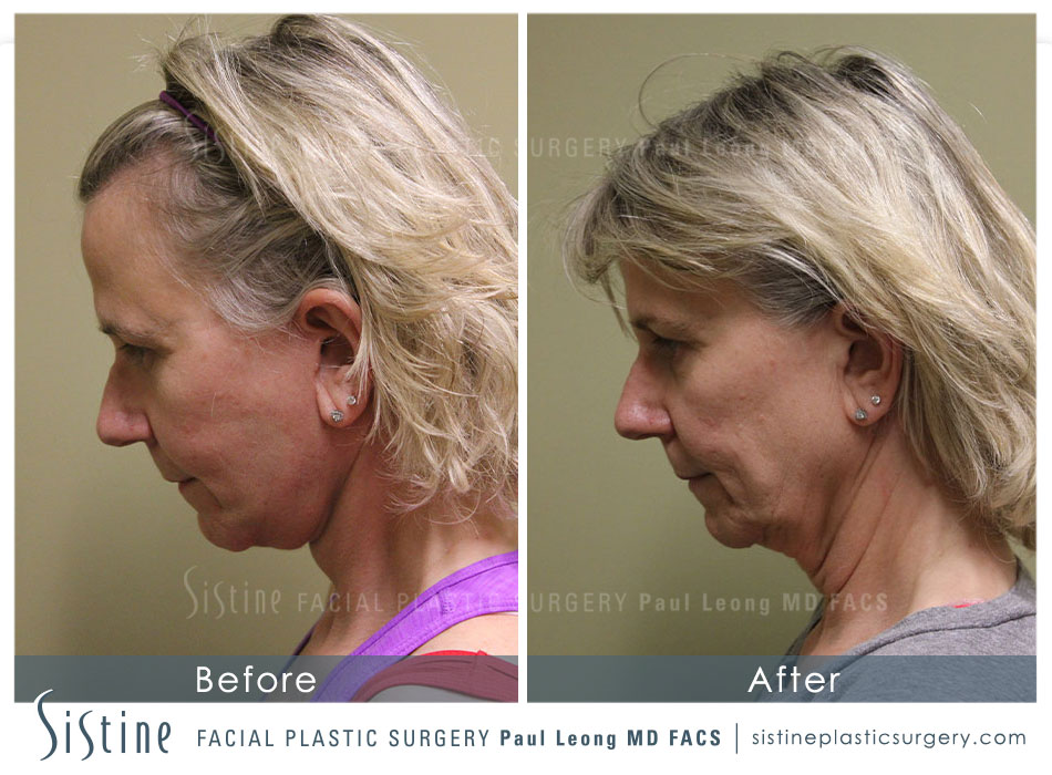 Facelift Before & After Gallery - Patient 4883637 - Image 6
