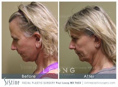 Facelift Before & After Gallery - Patient 4883637 - Image 6
