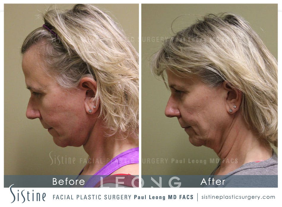 Facelift Before & After Gallery - Patient 4883637 - Image 6
