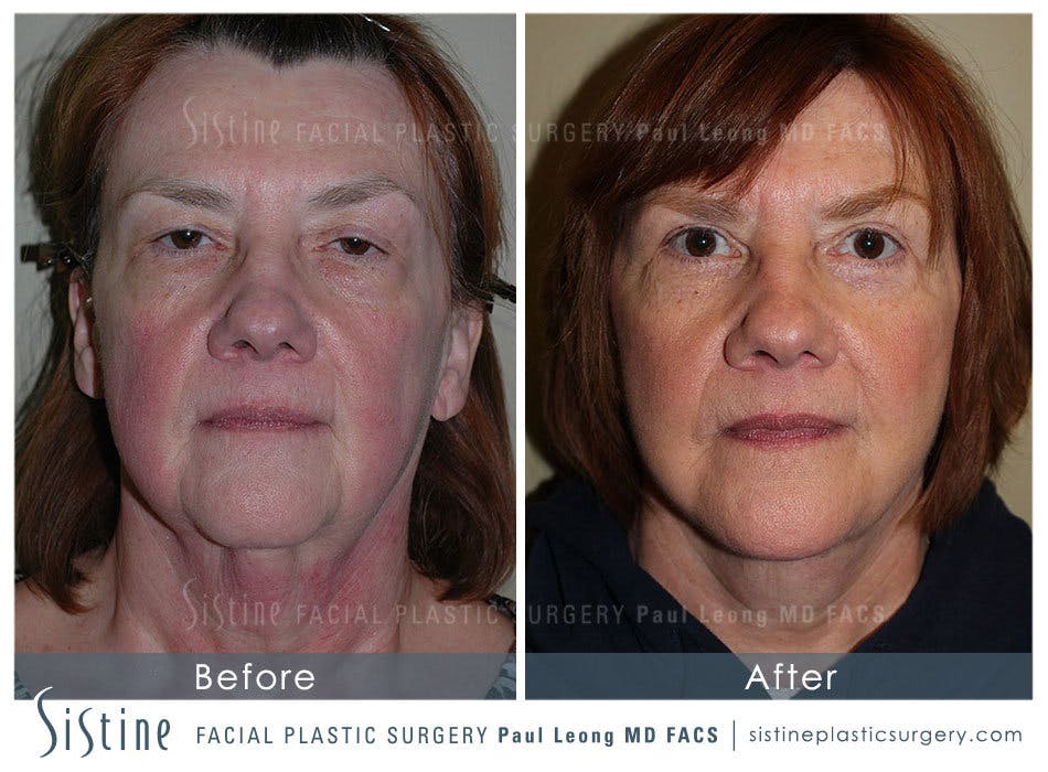 Facelift Before & After Gallery - Patient 4883638 - Image 1