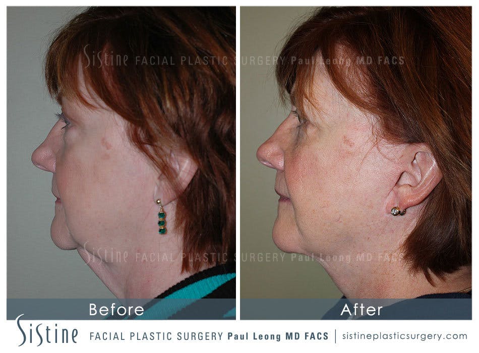 Facelift Before & After Gallery - Patient 4883638 - Image 5