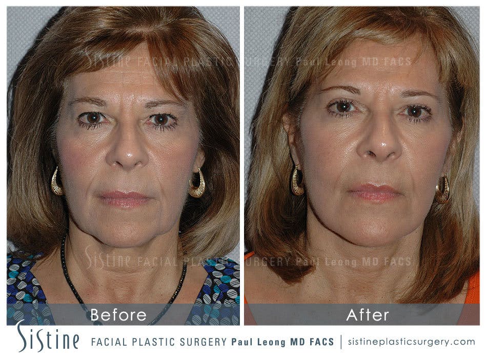 Facelift Before & After Gallery - Patient 4883639 - Image 1